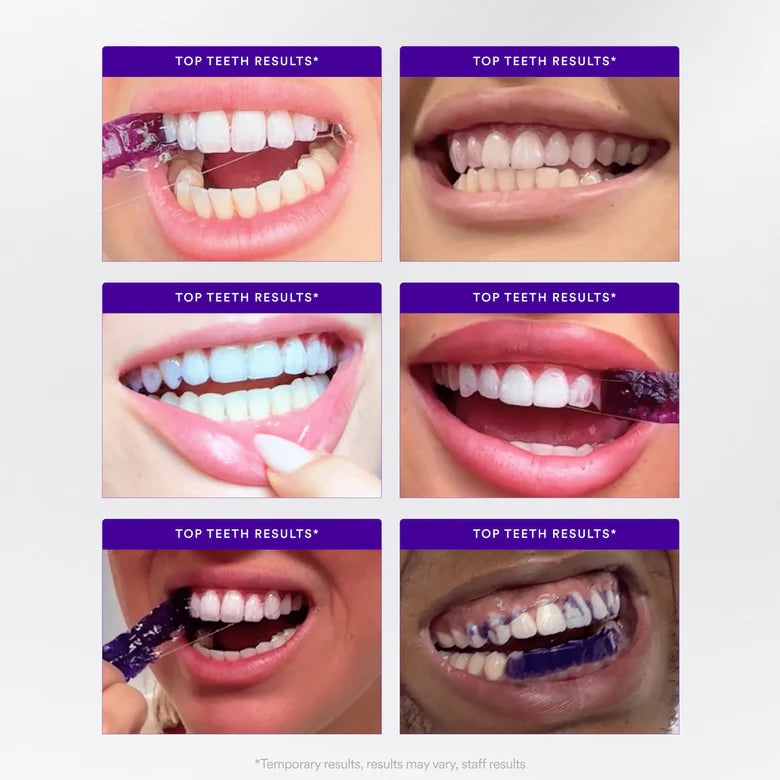 Colour corrected teeth covered in V34 Colour Corrector Serum and home teeth whitened Colour corrected teeth covered in V34 Colour Corrector Serum and home teeth whitened