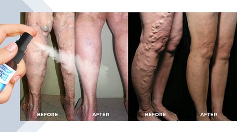 Leg health
